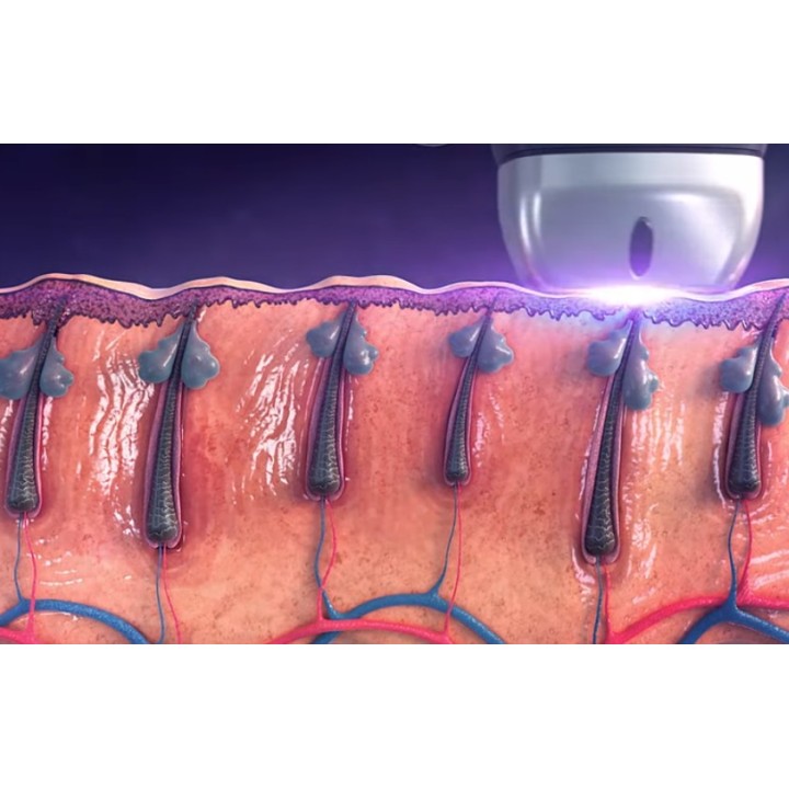 Epiliacijos Titanium diodo lazeris SHR 808 nm | Medisa.lt