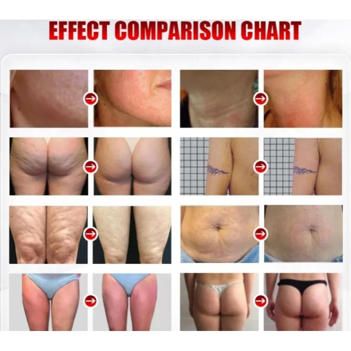 Velashape Vakuuminis RF lieknėjimo aparatas | Medisa.lt