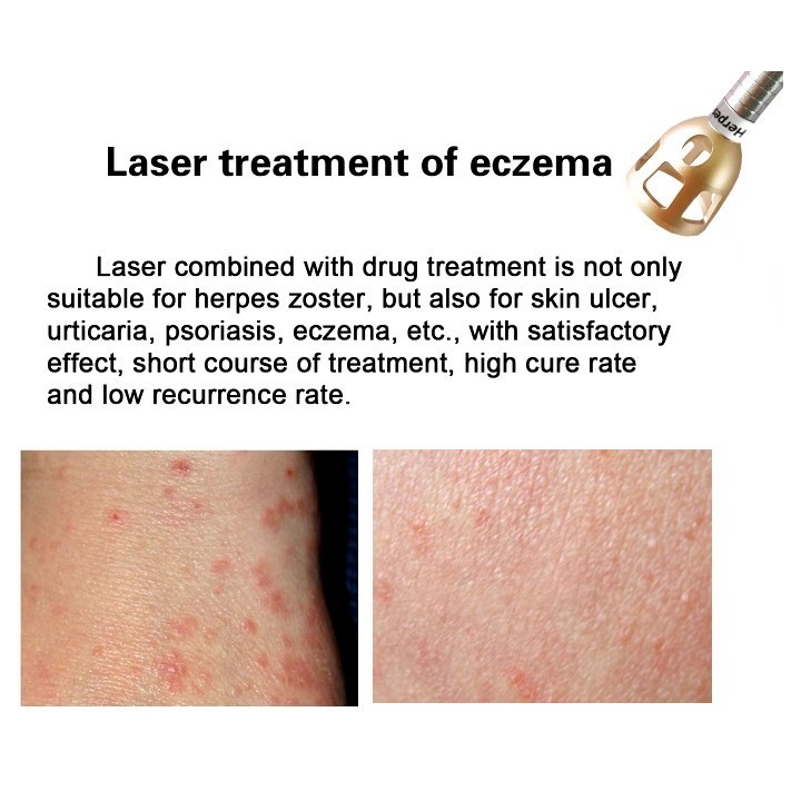 Odos atjauninimo fizioterapijos 980nm diodo lazeris | Medisa.lt