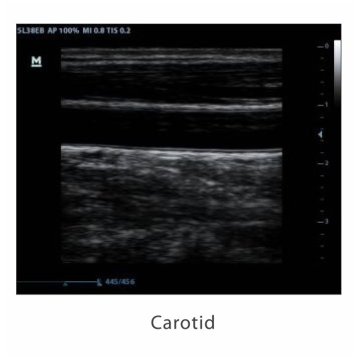 Mindray skaitmeninis ultragarso aparatas | Medisa.lt
