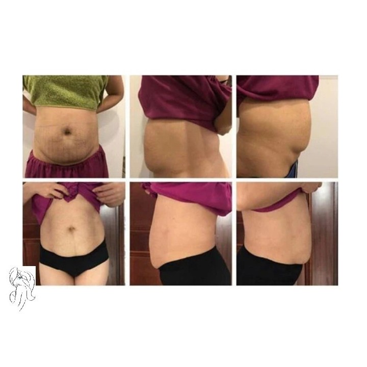 HIFU liposakcinis kūno liekninimo aparats | Medisa.lt
