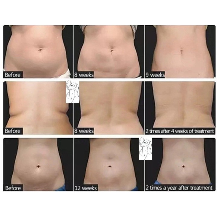 HIFU liposakcinis kūno liekninimo aparats | Medisa.lt