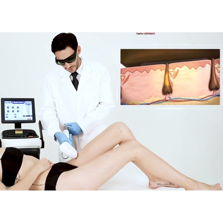 Epiliacijos diodo lazeris 808 nm | Medisa.lt