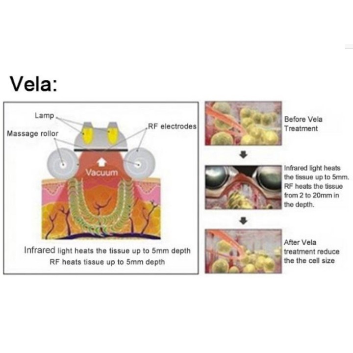 Kavitacijos Vakuumo Vela RF Lazerio aparatas | Medisa.lt