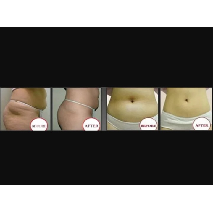 Krioterapijos kriolipolizės RF Lipo Lazerio aparatas | Medisa.lt