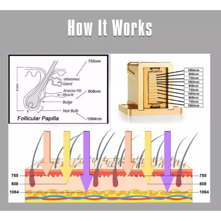 Epiliacijos diodo lazeris 808 nm | Medisa.lt