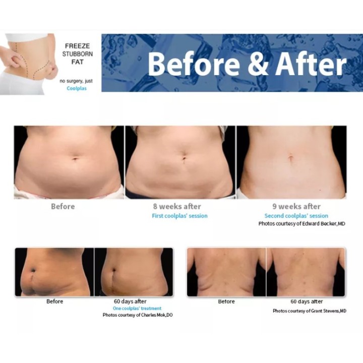 Kriolipolizės 4D 7D aparatas | Medisa.lt