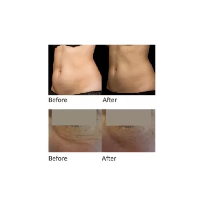 HIFU Veido Kūno ultragarsinis liposakcinis aparatas | Medisa.lt