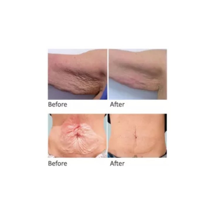 HIFU Veido Kūno ultragarsinis liposakcinis aparatas | Medisa.lt