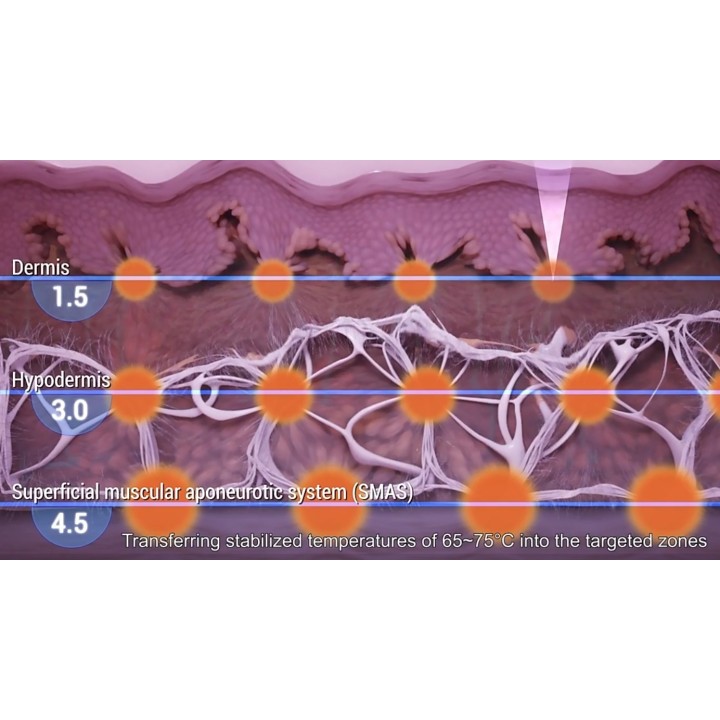 HIFU Veido Kūno ultragarsinis liposakcinis aparatas | Medisa.lt