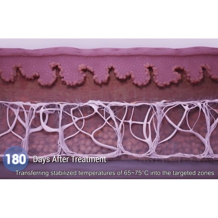 HIFU Veido Kūno ultragarsinis liposakcinis aparatas | Medisa.lt