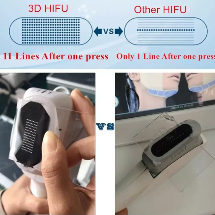 HIFU veido kūno liekninimo formavimo aparatas 3D | Medisa.lt