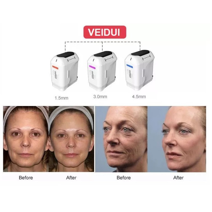 HIFU veido kūno liekninimo formavimo aparatas 3D | Medisa.lt