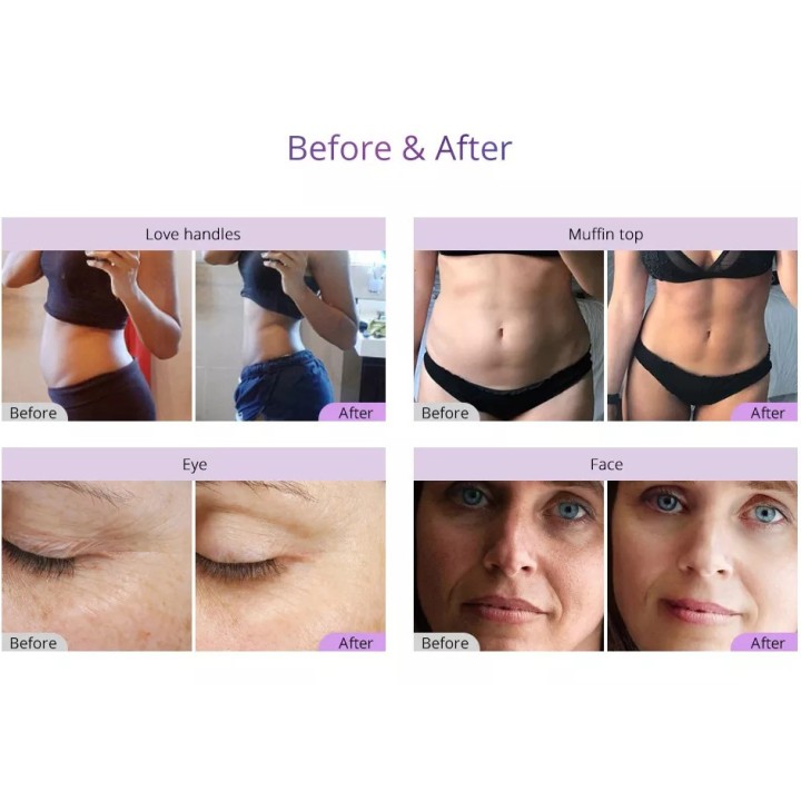 Ultragarso kavitacijos vakuuminis RF lipo lazerinis | Medisa.lt