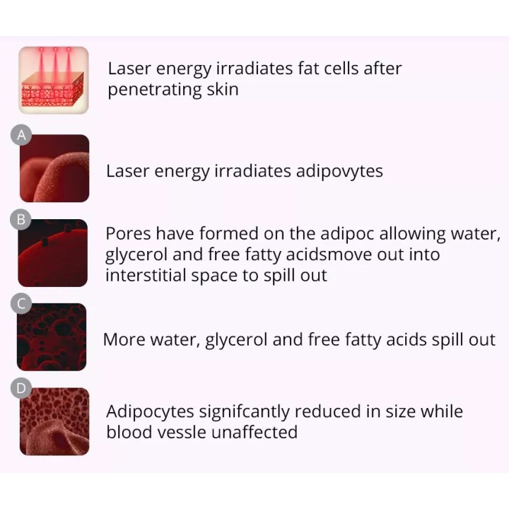 Ultragarso kavitacijos vakuuminis RF Bio lipo lazerinis | Medisa.lt