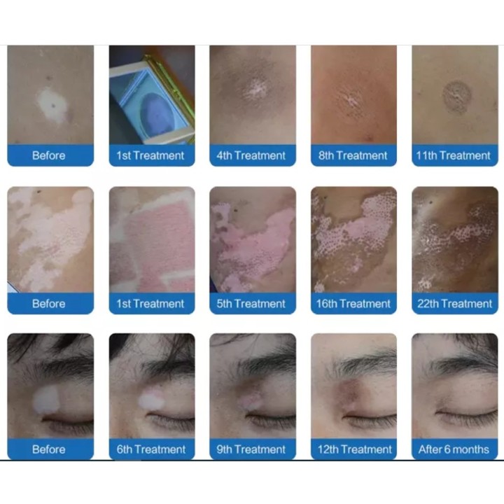 Psoriazės Vitiligo Eksimerinis 308nm lazeris | Medisa.lt