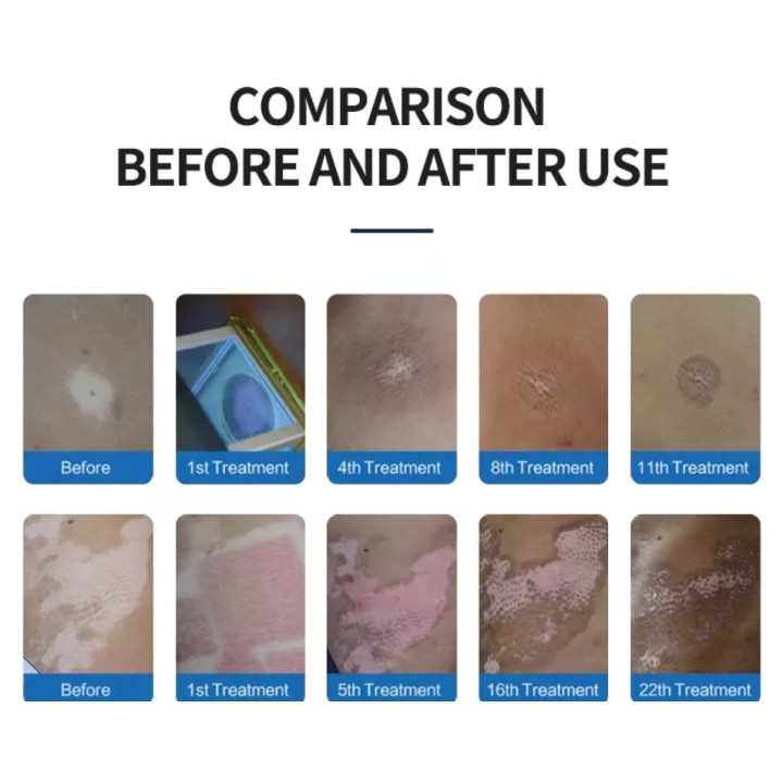 Psoriazės Vitiligo Eksimerinis 308nm lazeris | Medisa.lt