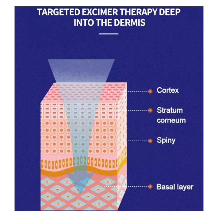 Psoriazės Vitiligo Eksimerinis 308nm lazeris | Medisa.lt
