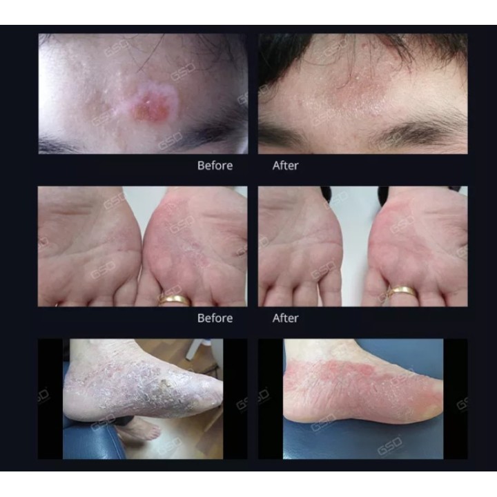 Psoriazės vitiligo eksimerinis 308nm lazeris | Medisa.lt
