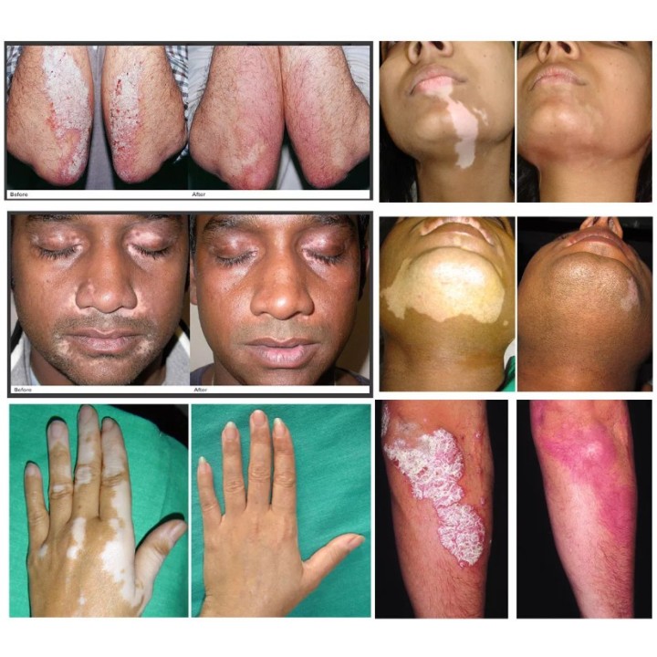 Psoriazės vitiligo psoriazės egzemos grybelinės mikozės | Medisa.lt